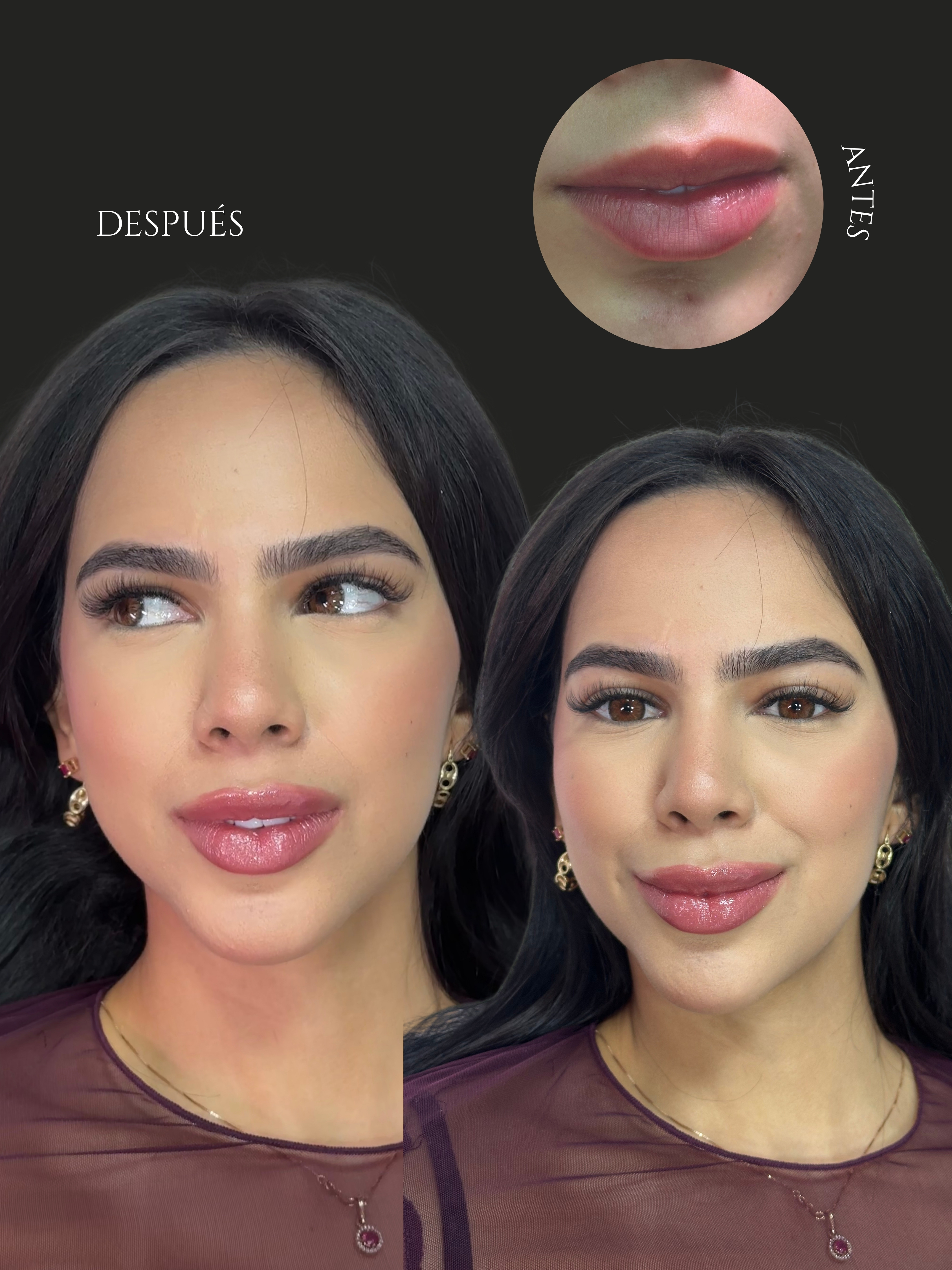 Resultado SS Heart Lips™ — paciente 2