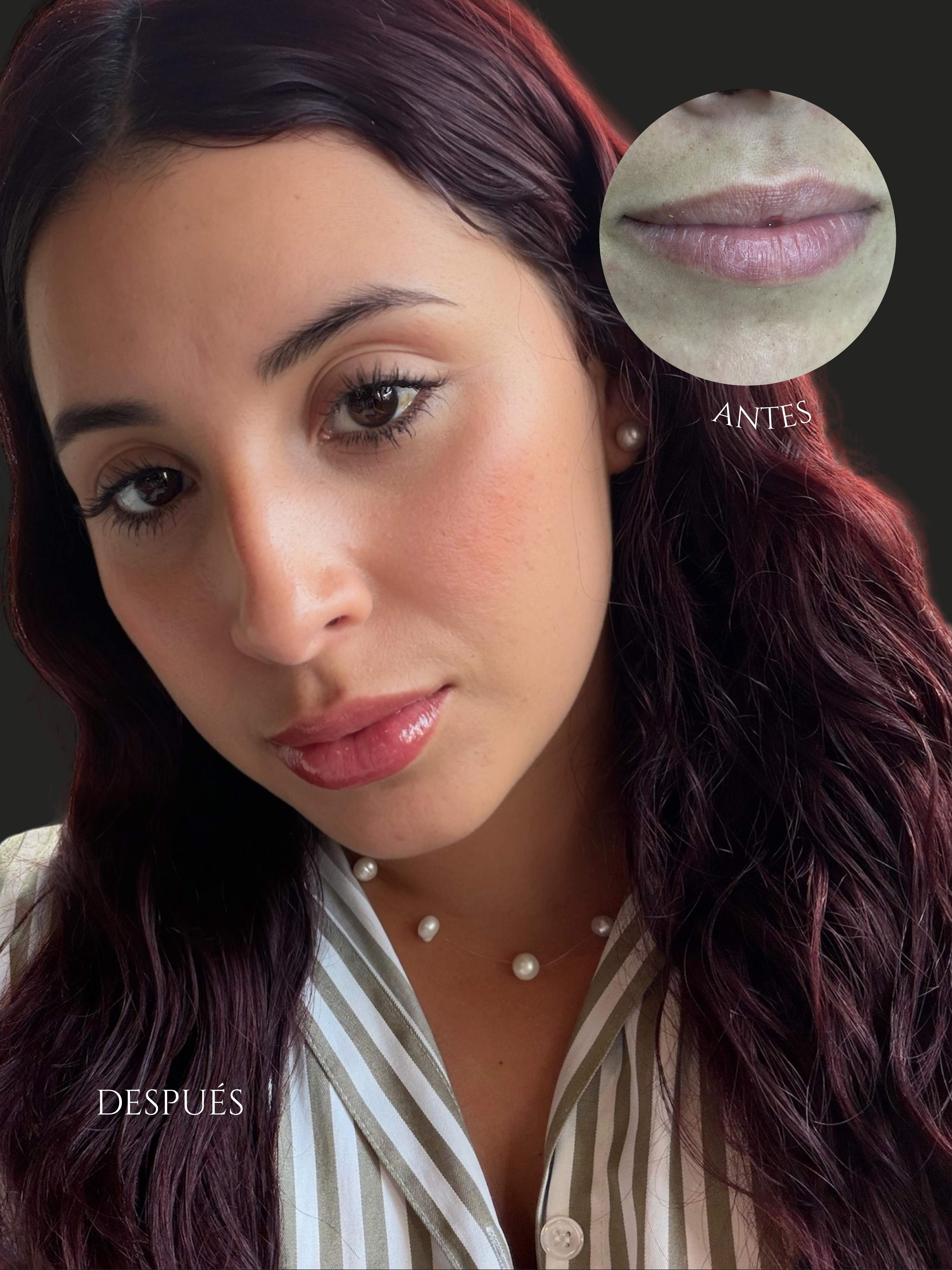 Resultado SS Heart Lips™ — paciente 3