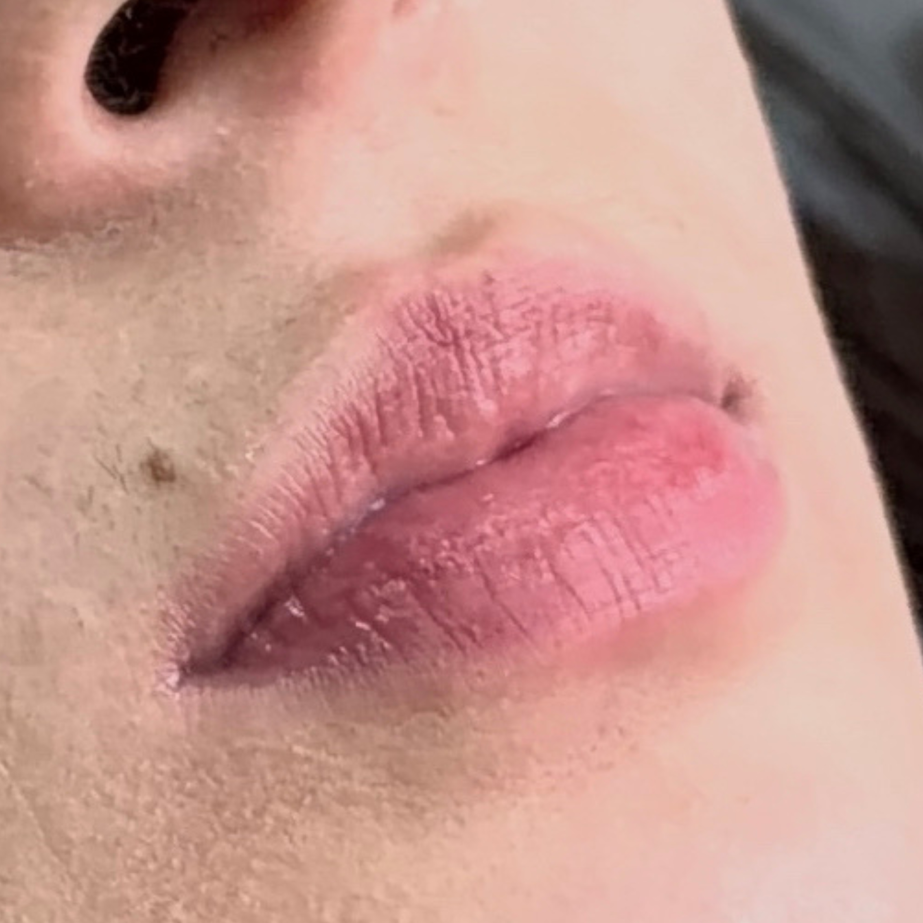 Caso 1 antes SS Heart Lips™