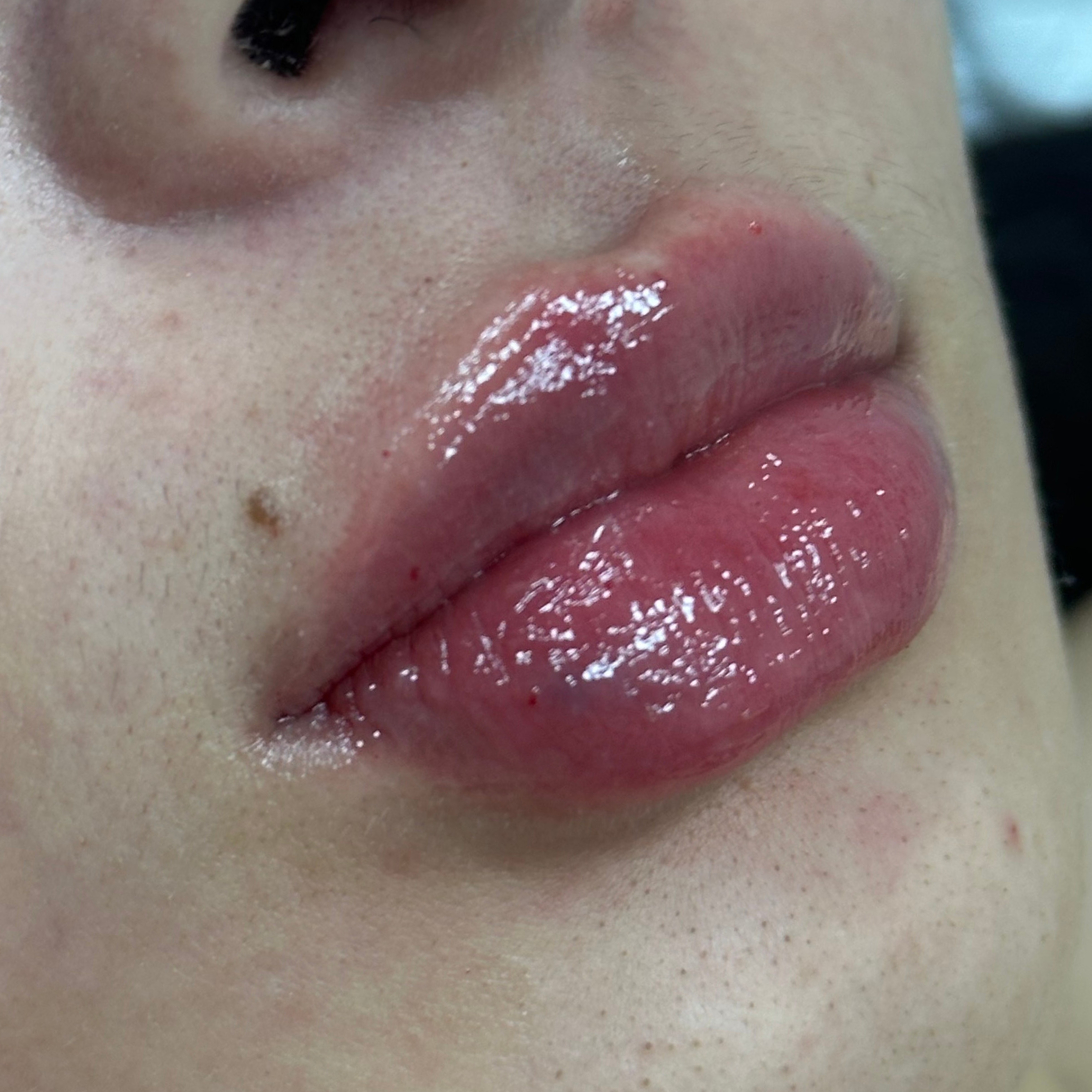Caso 1 después SS Heart Lips™