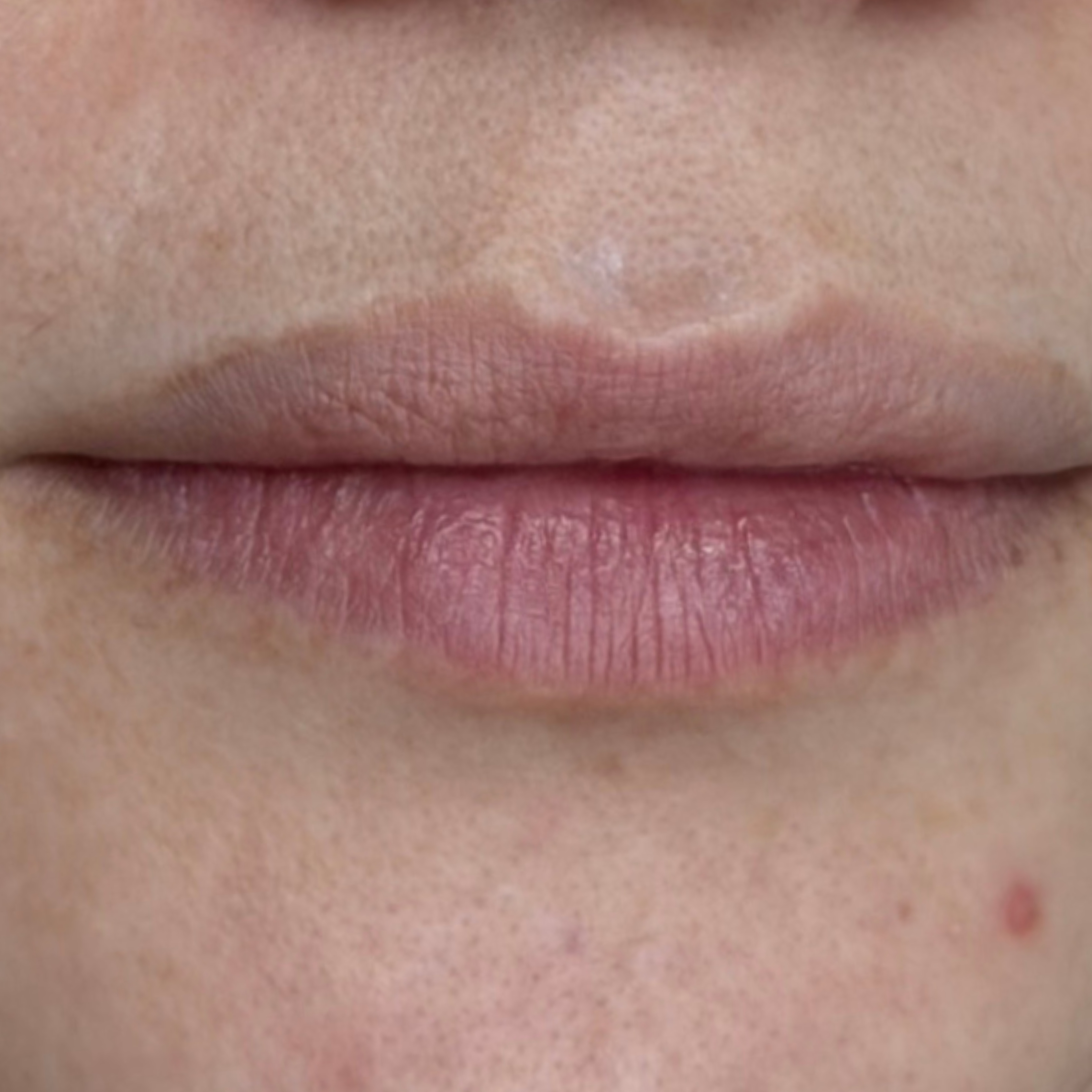 Caso 3 antes SS Heart Lips™