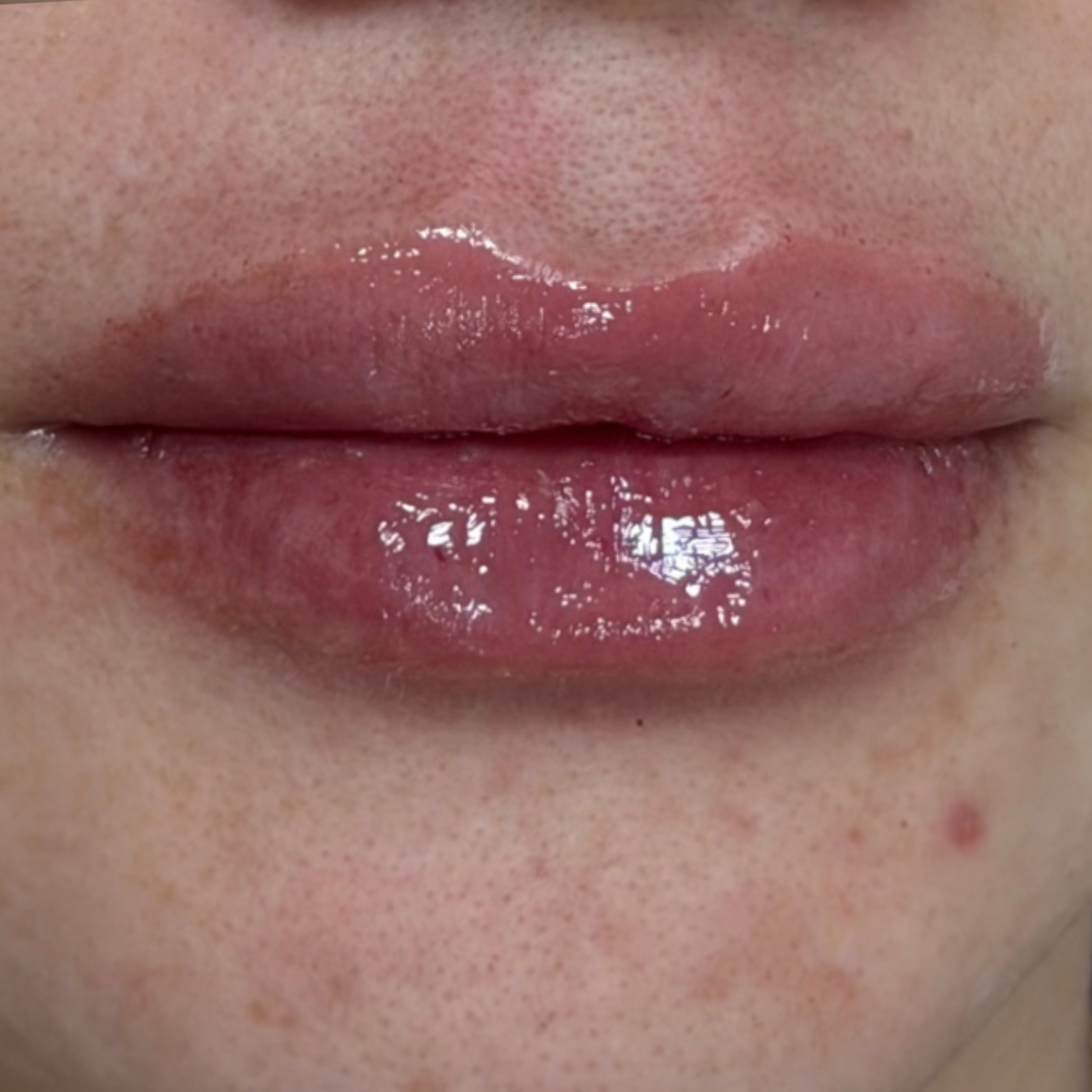 Caso 3 después SS Heart Lips™