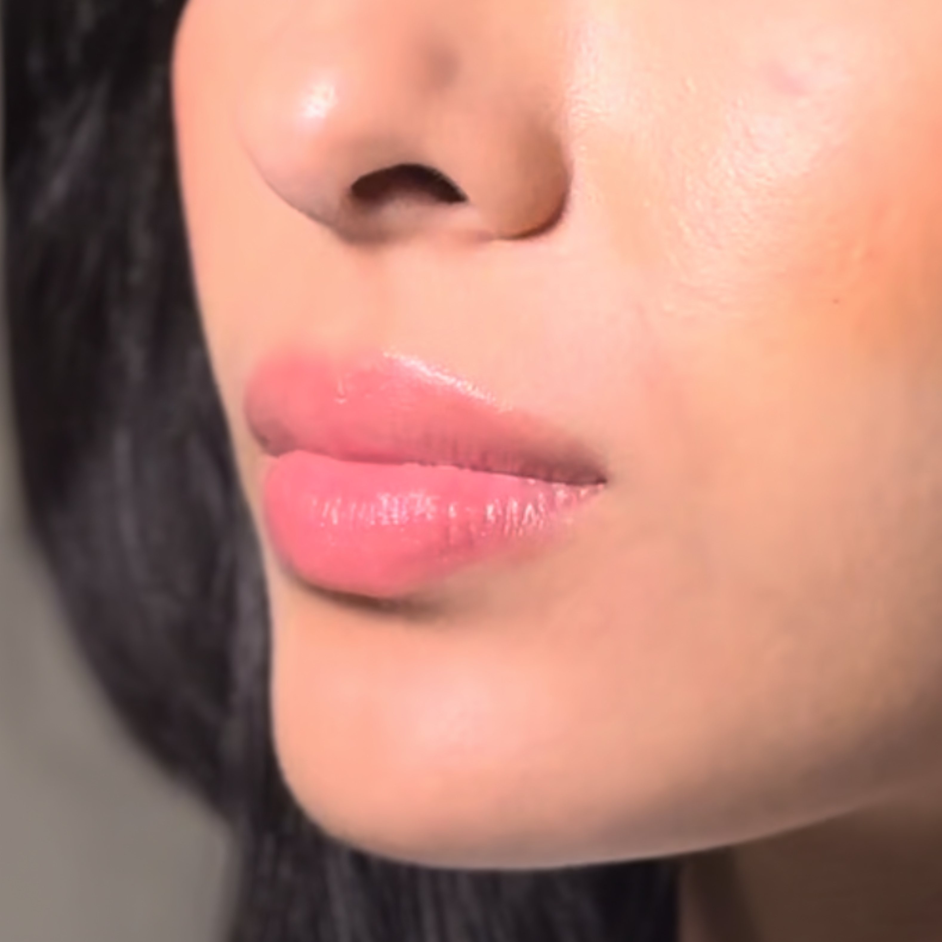 Caso 4 antes SS Heart Lips™