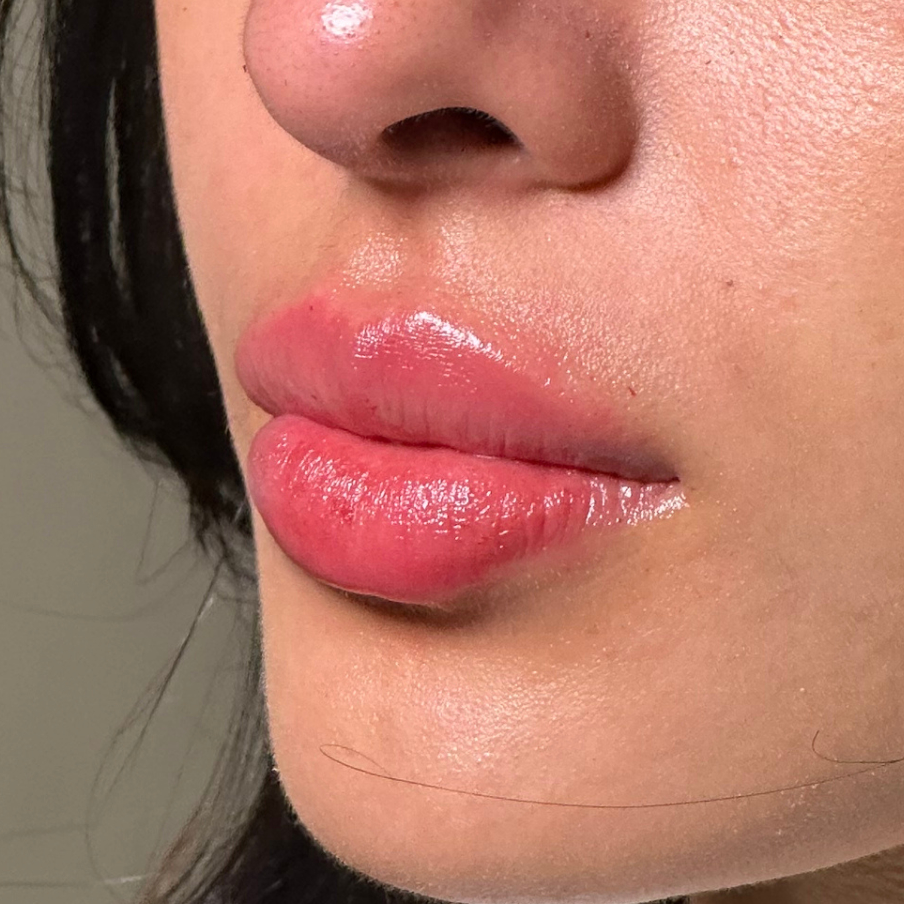 Caso 4 después SS Heart Lips™