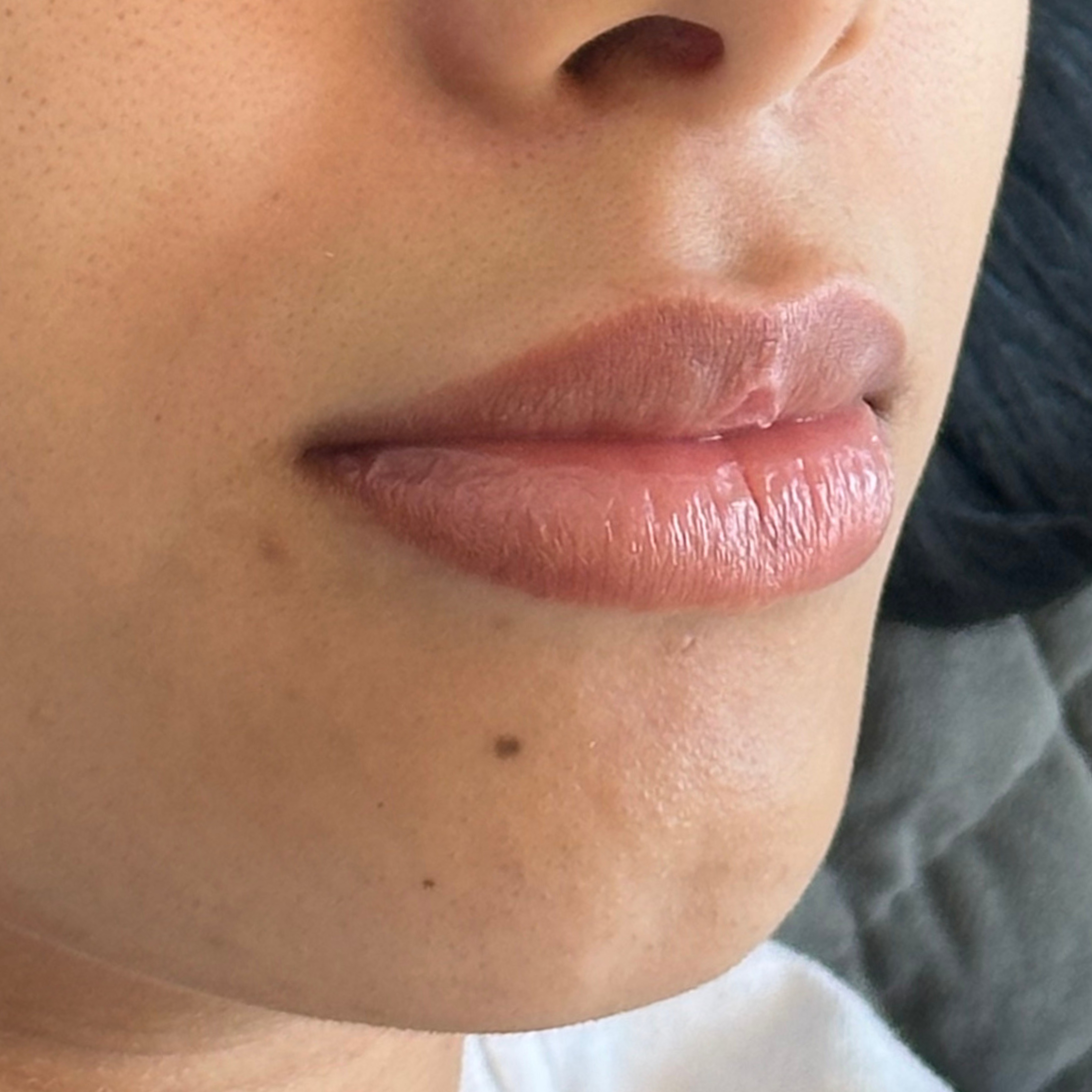 Caso 5 antes SS Heart Lips™
