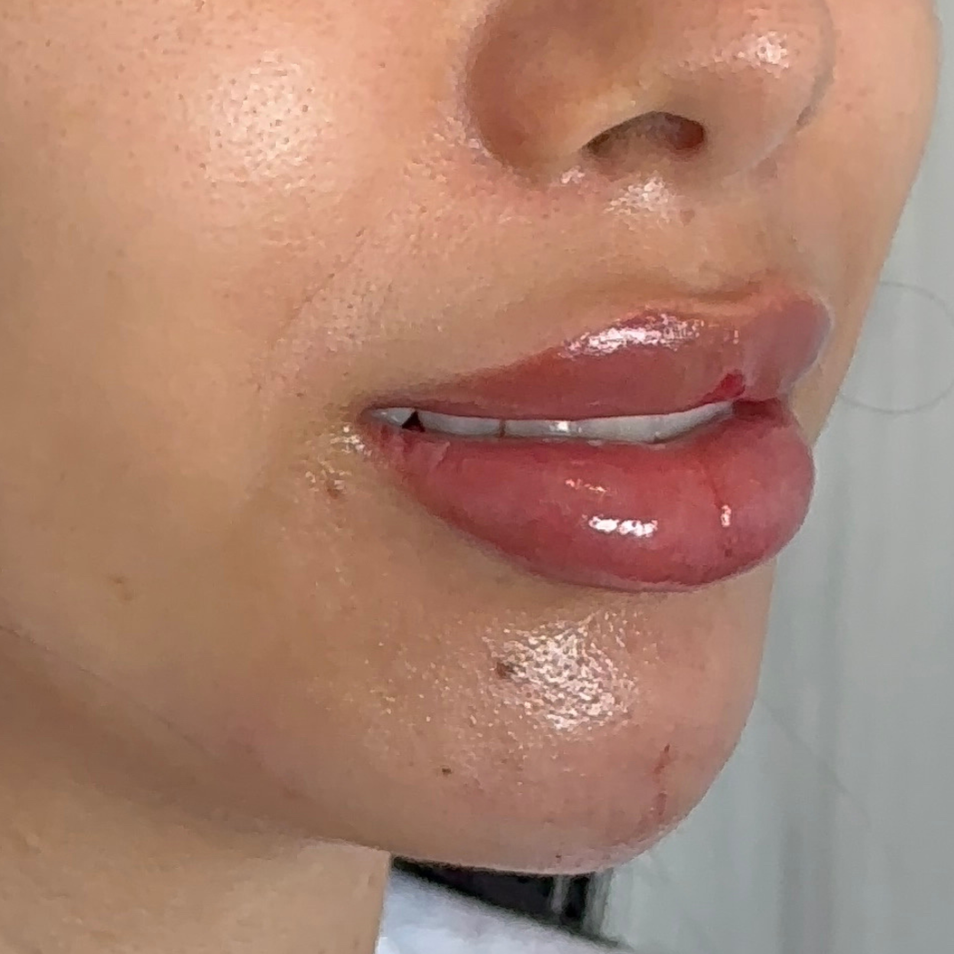 Caso 5 después SS Heart Lips™