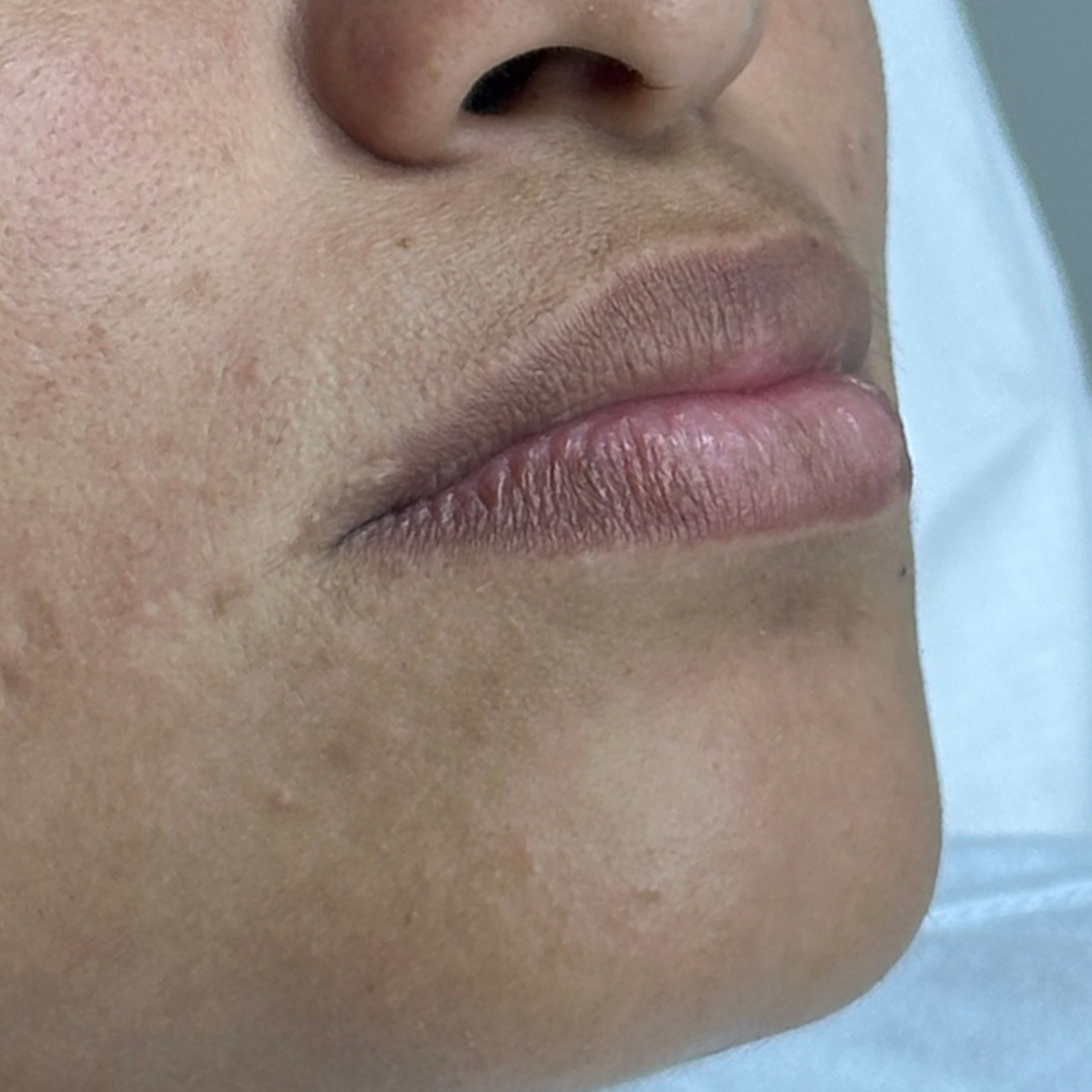 Caso 6 antes SS Heart Lips™