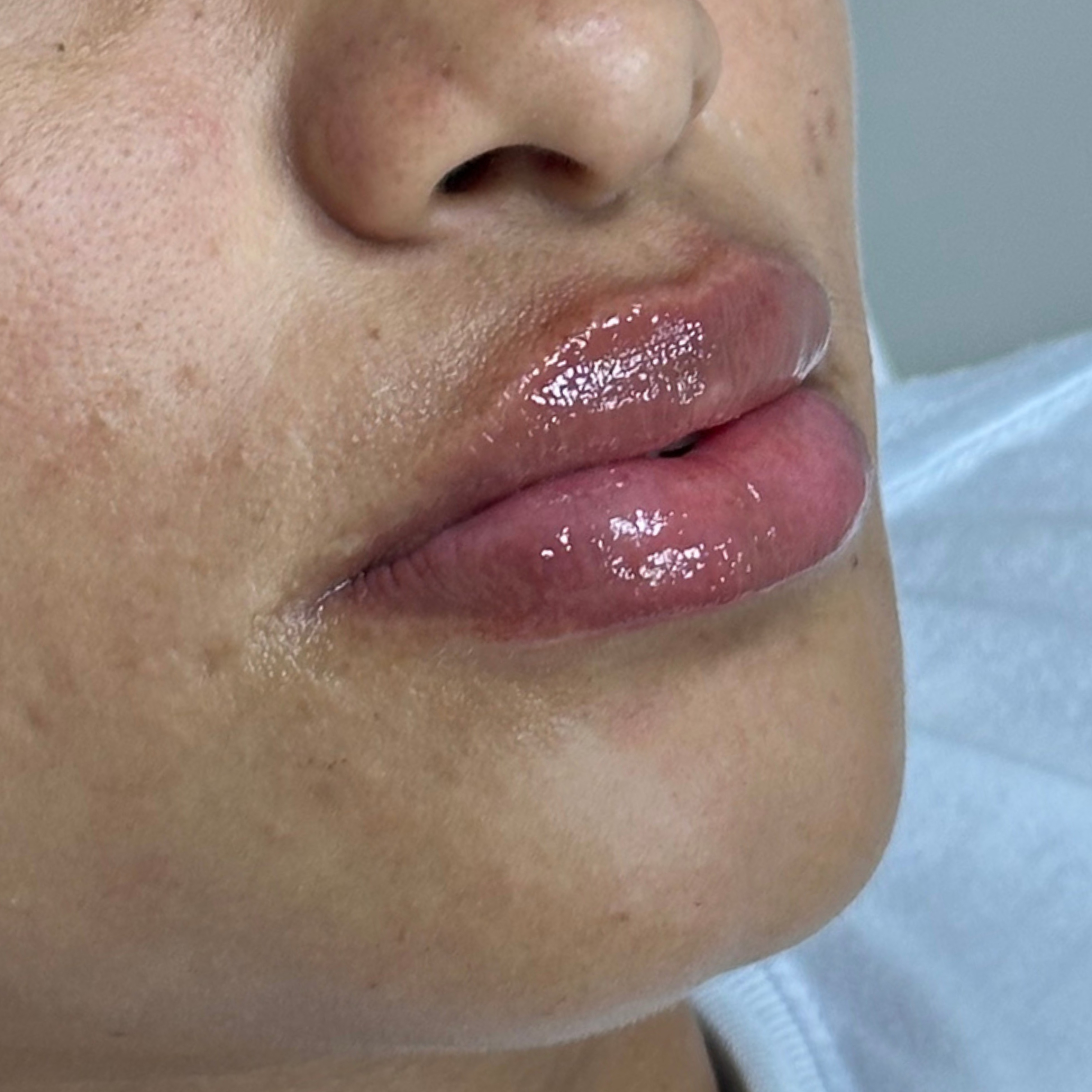 Caso 6 después SS Heart Lips™