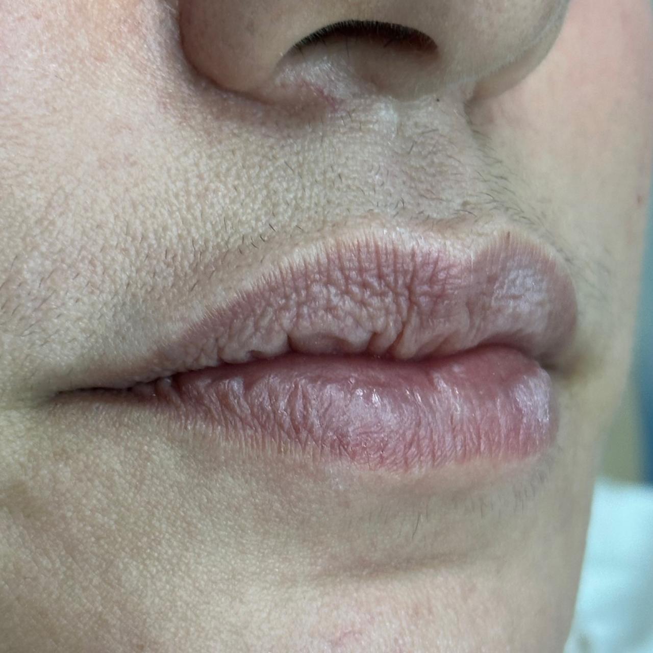 Antes de Diseño de Labios