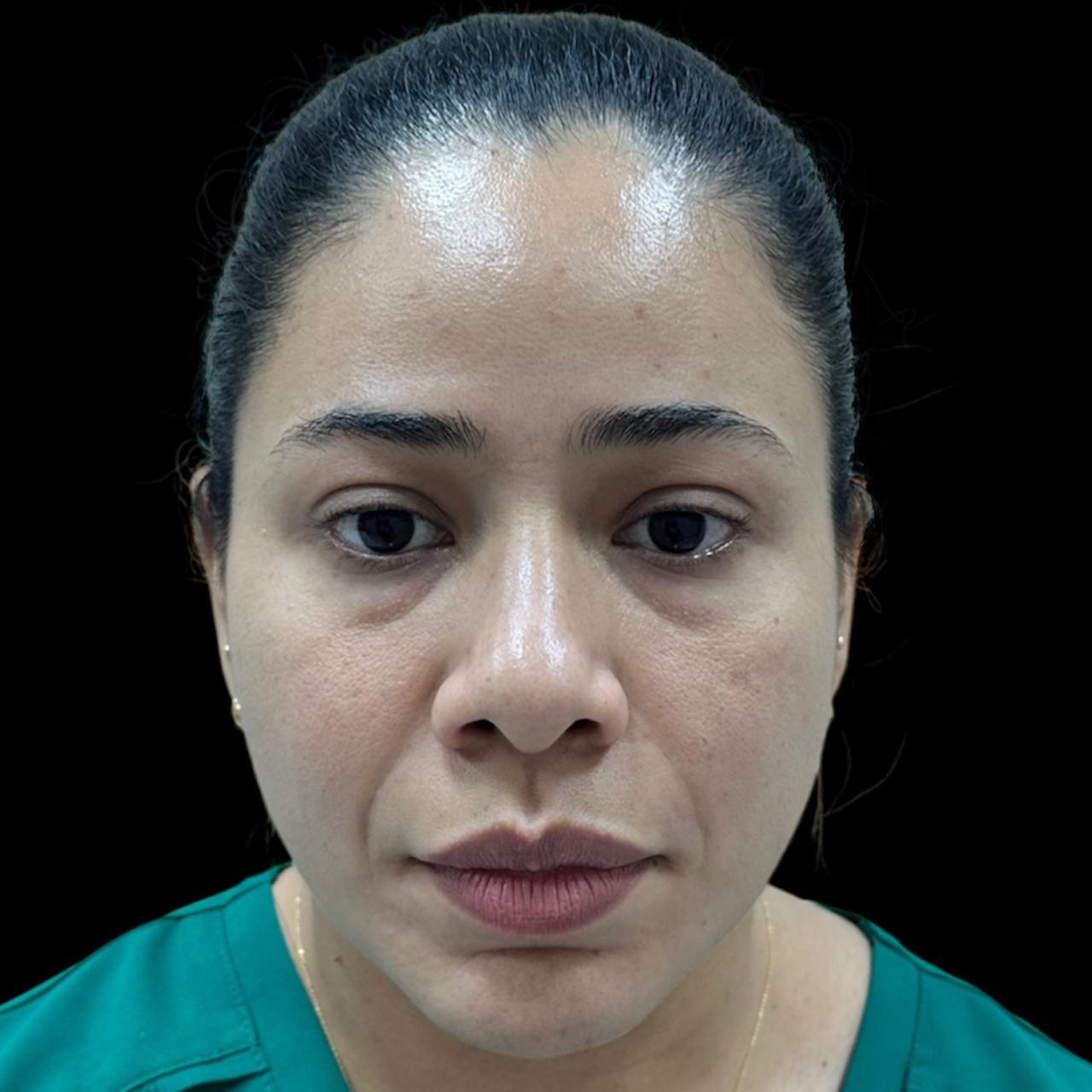 Antes de Reposición Malar