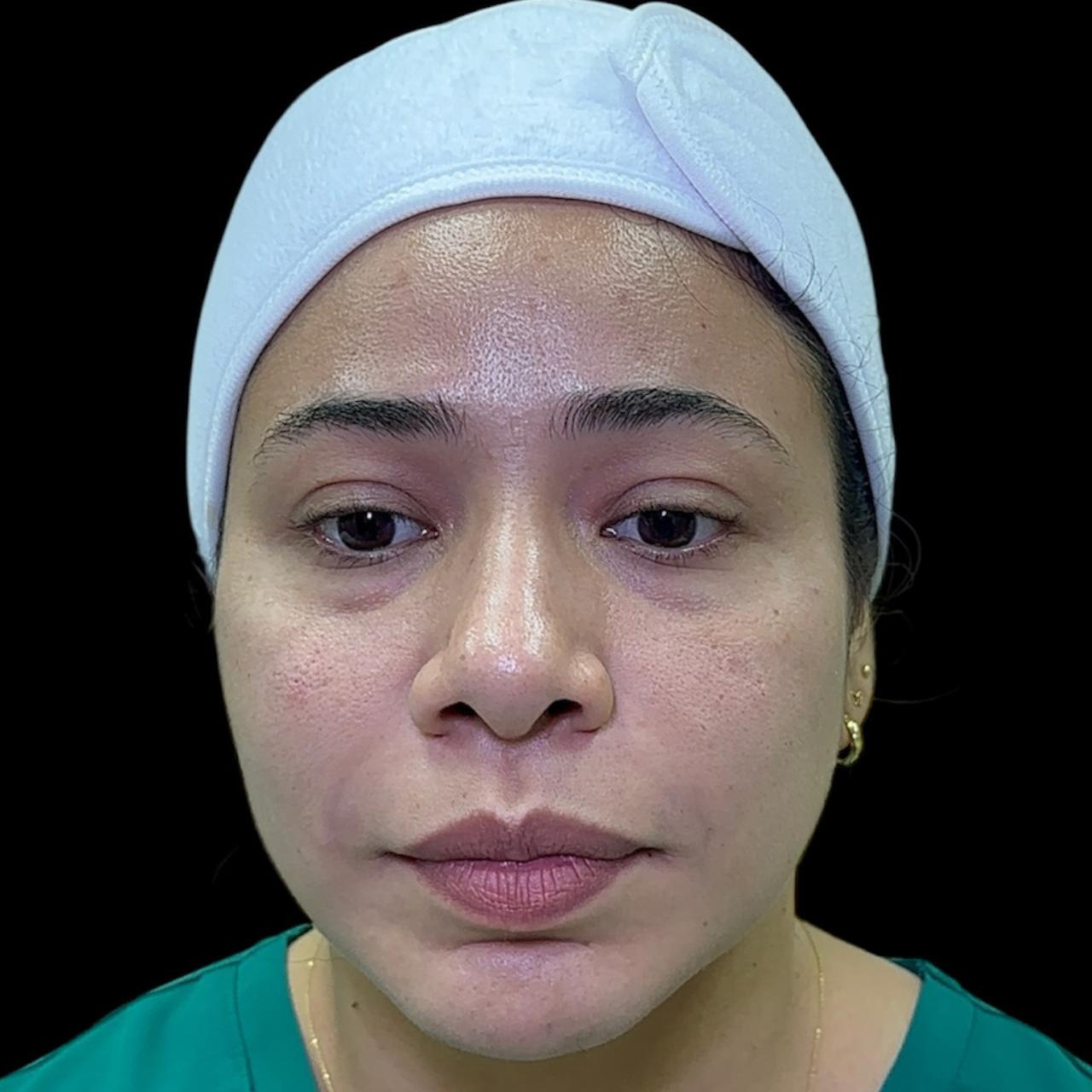 Después de Reposición Malar