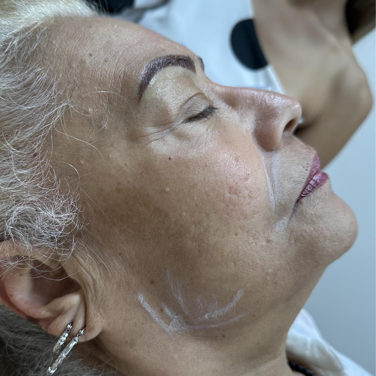 Antes de Marcación Mandibular