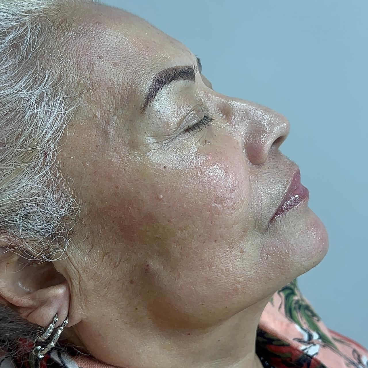 Después de Marcación Mandibular