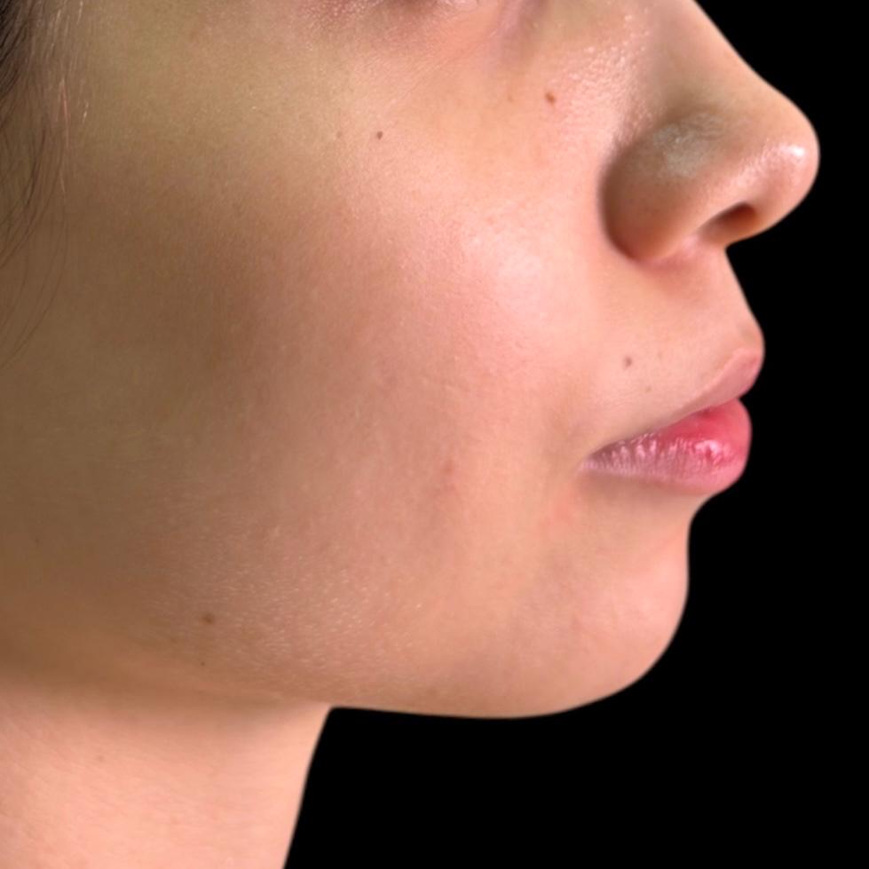 Antes de Perfilamiento de Mentón