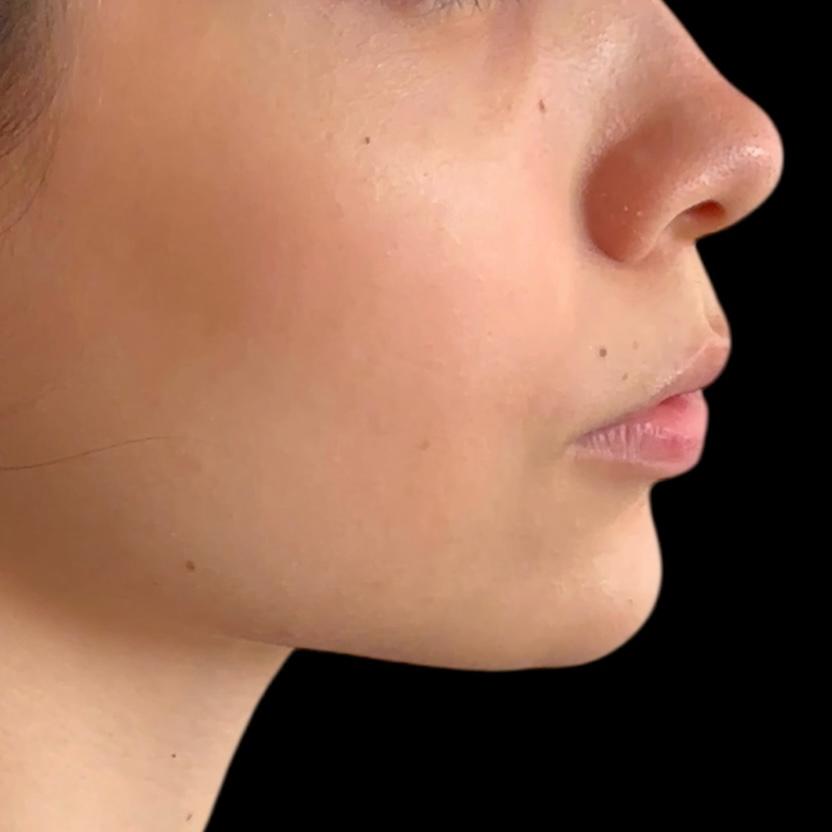 Después de Perfilamiento de Mentón