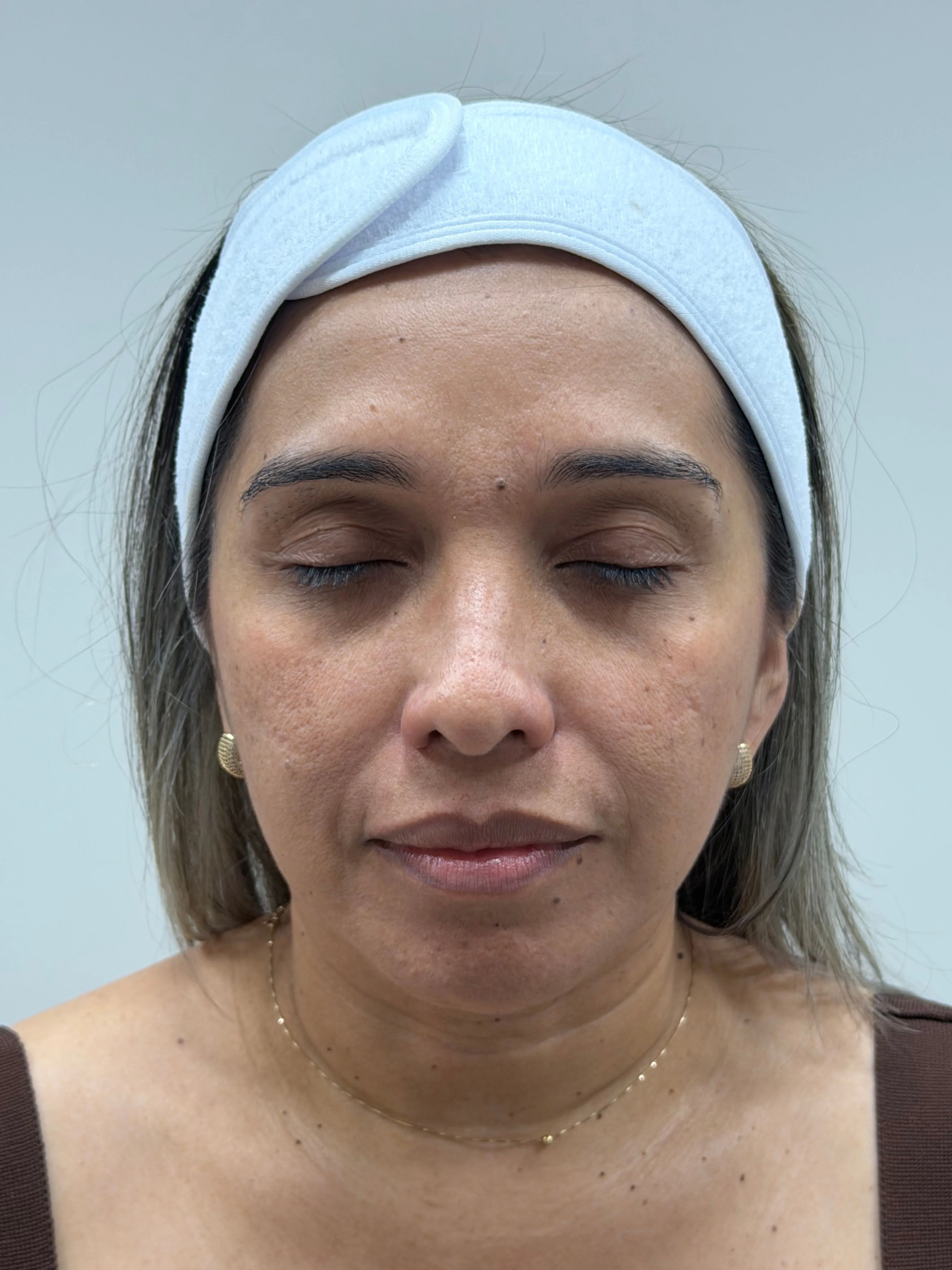 Antes · Rejuvenecimiento Facial