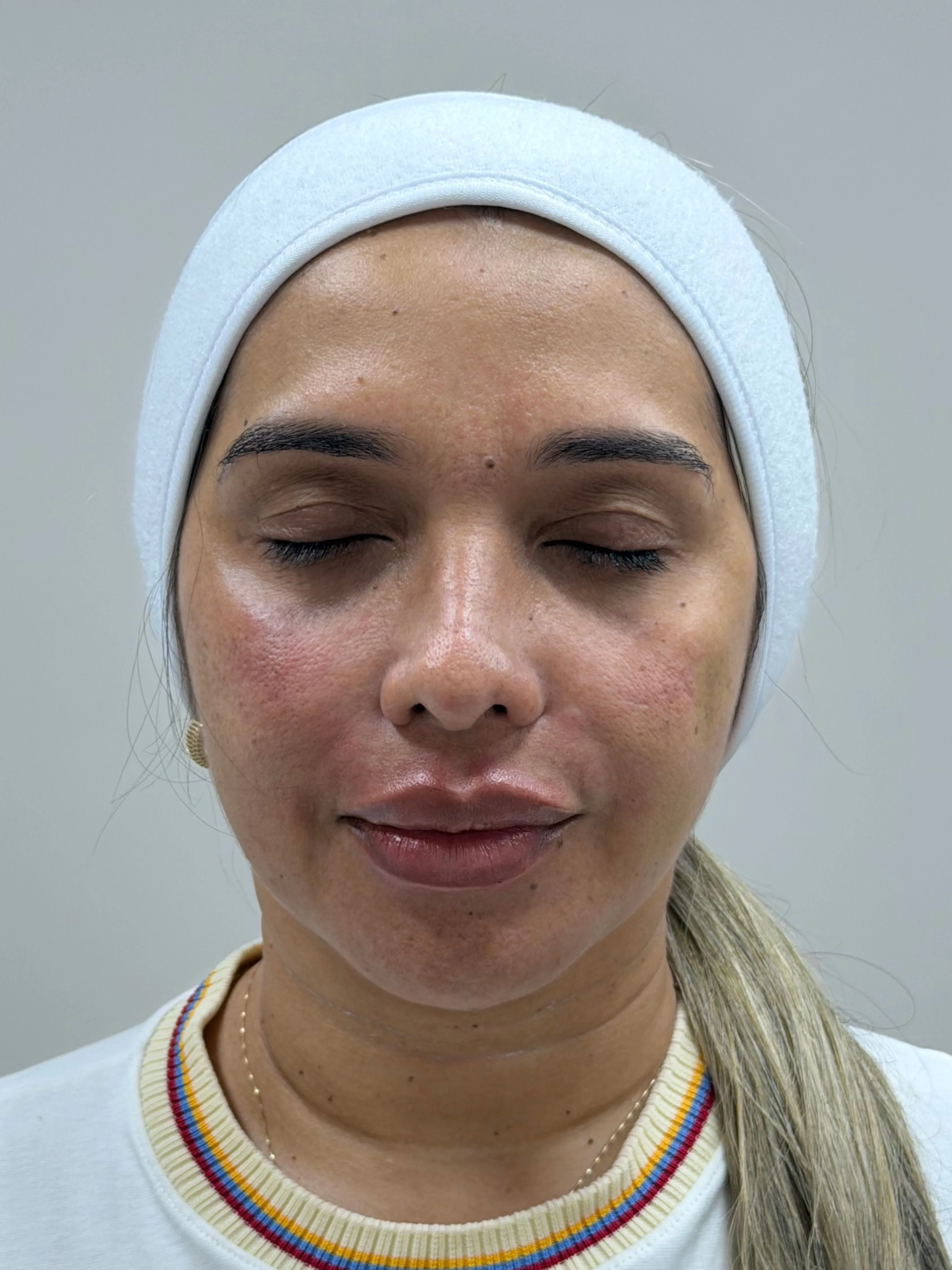 Después · Rejuvenecimiento Facial