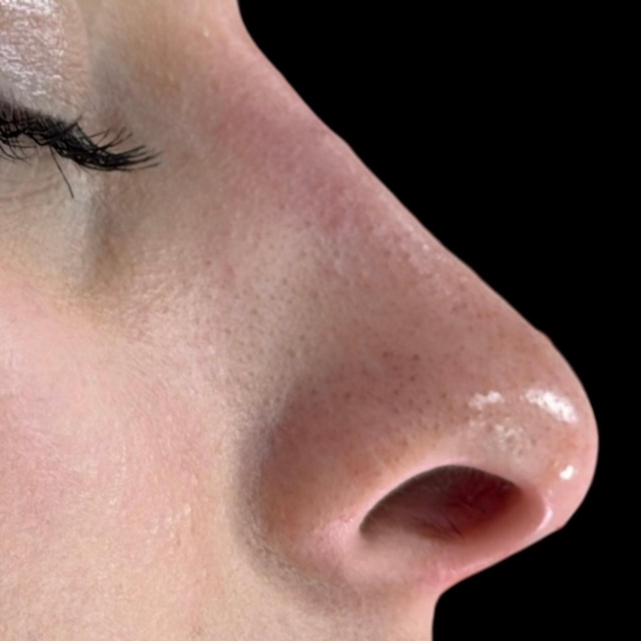 Después de Rinomodelación